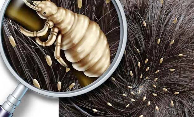5 Cara Menghilangkan Kutu Rambut