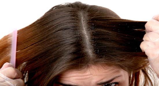 menghilangkan kutu rambut